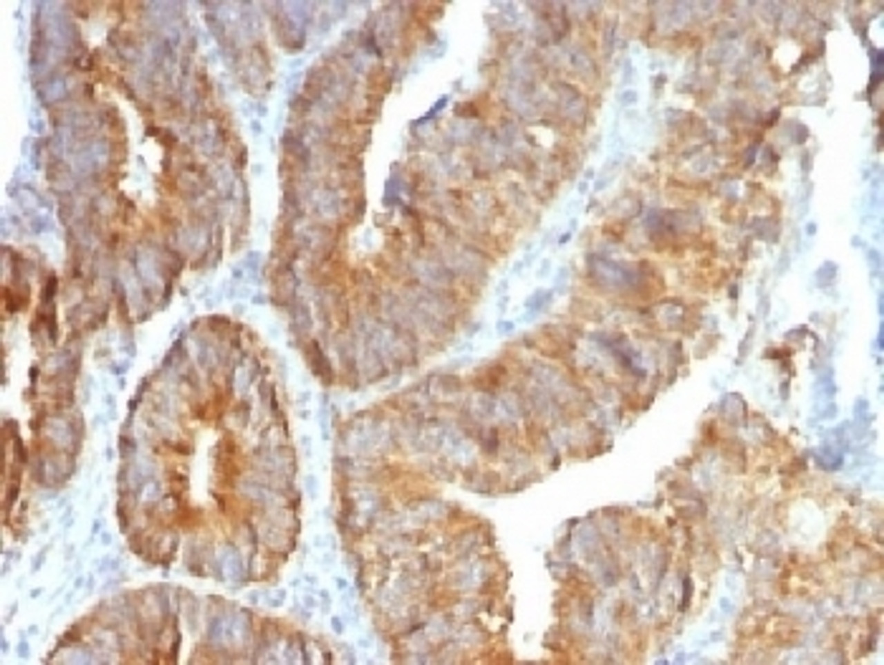 IHC testing of FFPE human colon carcinoma with TL1A antibody (clone VEGI/1283) . Required HIER: boil sections in 10mM Tris with 1mM EDTA, pH9, for 10-20 min followed by cooling at RT for 20 min.