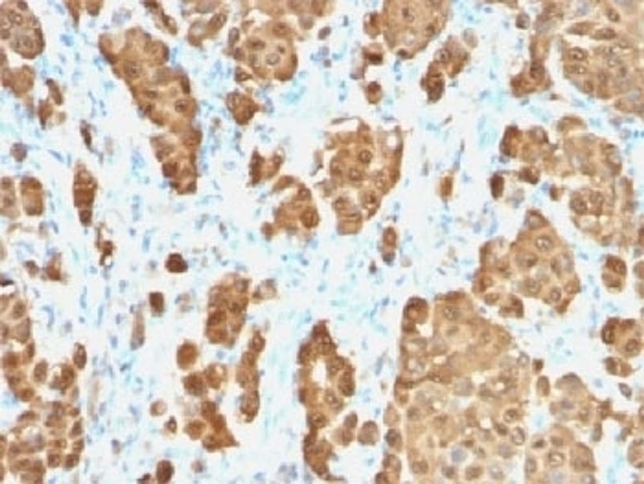 IHC testing of FFPE human melanoma with recombinant S100B antibody (clone S100B/1706R) . HIER: steam sections in 10mM citrate buffer, pH 6.0, for 10-20 min.