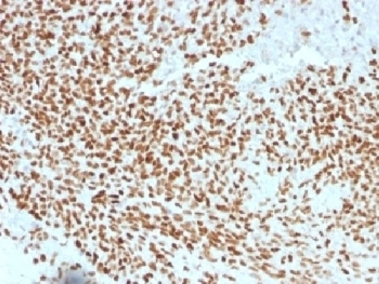 IHC testing of FFPE Ewings sarcoma with NKX2.2 antibody (clone NX2/1523) . HIER: steam sections in 10mM citrate buffer, pH 6.0, for 10-20 min.