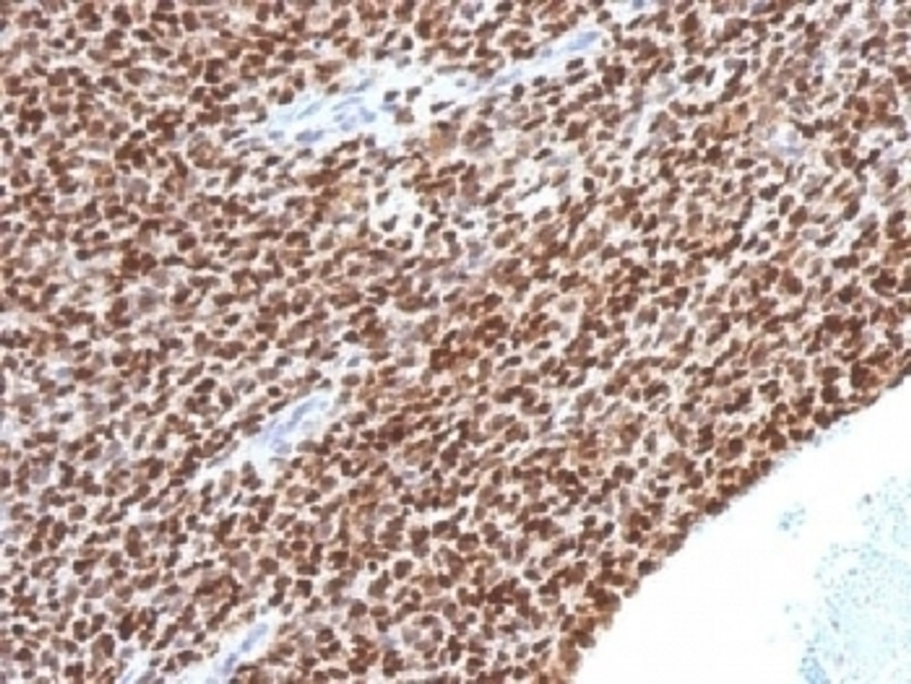 IHC testing of FFPE Ewings sarcoma with NKX2.2 antibody (clone NX2/1524) . HIER: steam sections in 10mM citrate buffer, pH 6, for 10-20 min.