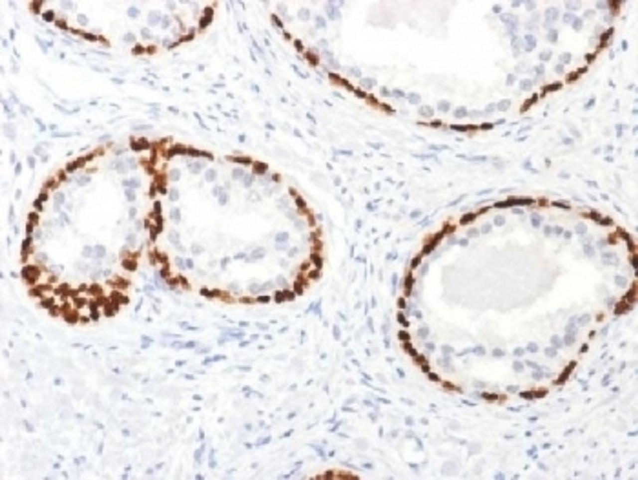 IHC testing of FFPE human prostate cancer tissue with p63 antibody. Required HIER: boil tissue sections in 10mM citrate buffer, pH 6, for 10-20 min.