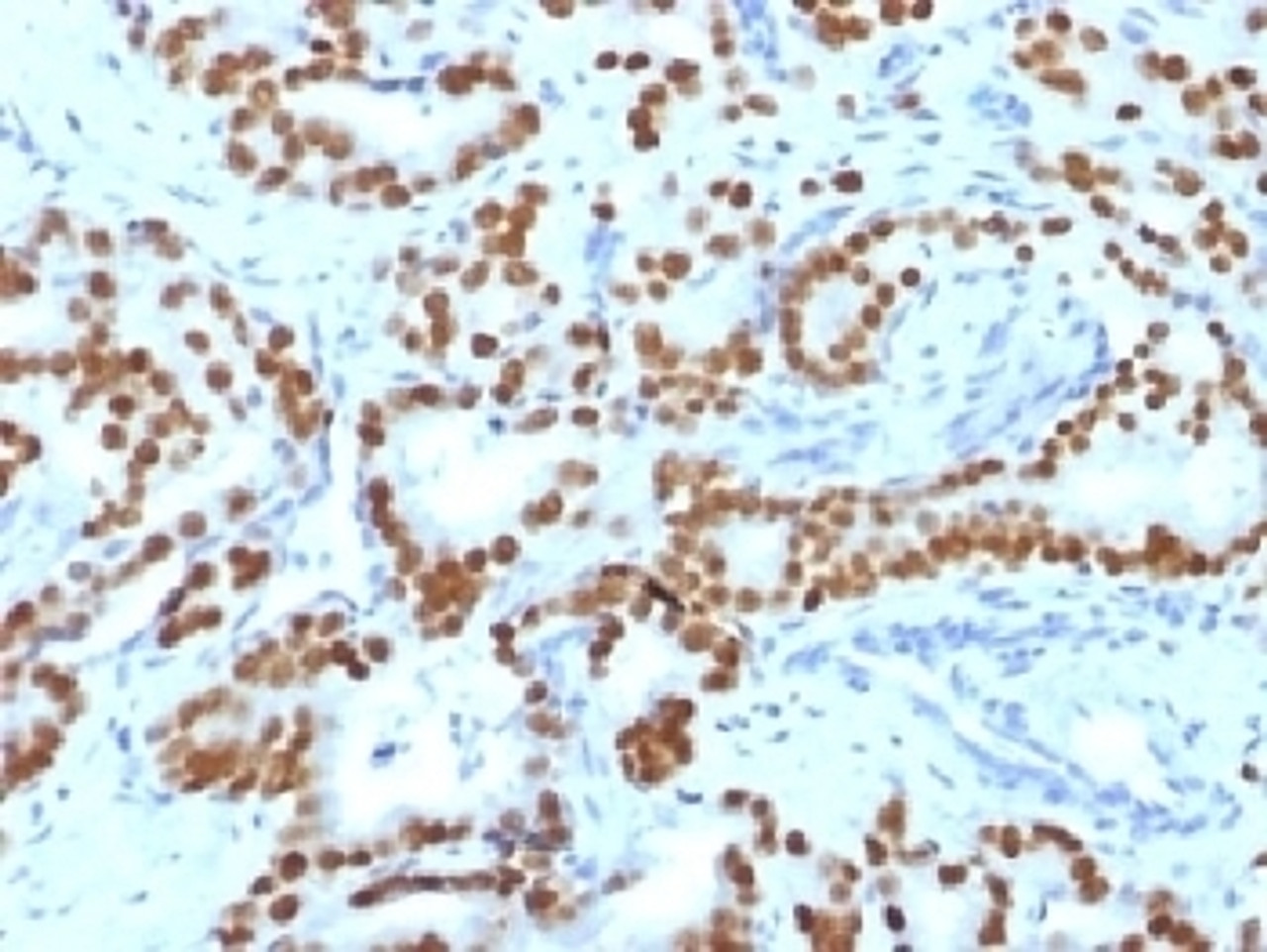 IHC testing of FFPE human prostate carcinoma with FOXA1 antibody (clone FOXA1/1519) . HIER: boil sections in 10mM Tris with 1mM EDTA, pH9, for 10-20 min.