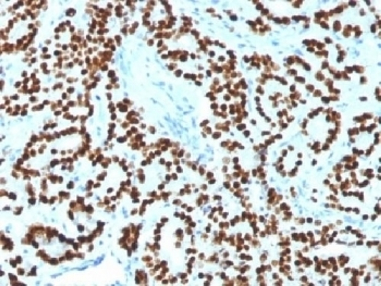 IHC testing of FFPE human prostate carcinoma with FOXA1 antibody (clone FOXA1/1518) . HIER: boil sections in 10mM Tris with 1mM EDTA, pH9, for 10-20 min.