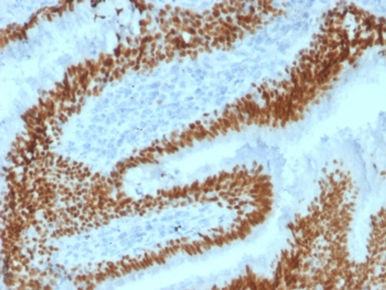 IHC testing of FFPE human lung carcinoma with SOX2 antibody (clone SOX2/1792) . Required HIER: boil tissue sections in 10mM citrate buffer, pH 6, for 10-20 min followed by cooling at RT for 20 min.