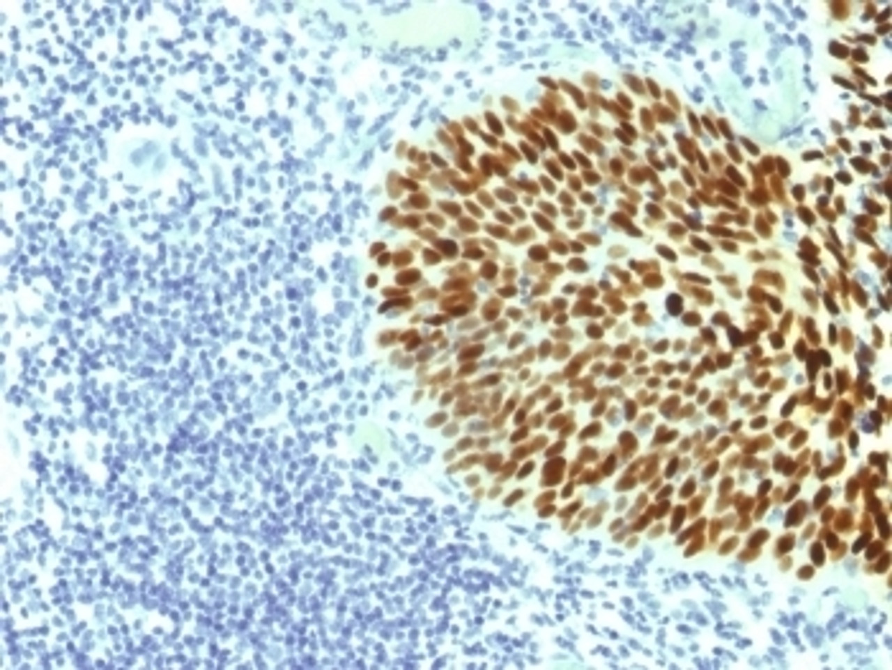 IHC testing of FFPE human cervical carcinoma with SOX-2 antibody (clone SOX2/1791) . Required HIER: boil tissue sections in 10mM citrate buffer, pH 6, for 10-20 min followed by cooling at RT for 20 min.