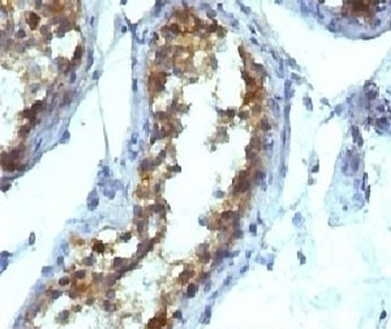 IHC testing of FFPE testicular carcinoma and Alkaline Phosphatase antibody (KSUL-1) . Required HIER: boil tissue sections in 10mM Tris with 1mM EDTA, pH 9, for 10-20 min followed by cooling at RT for 20 min.
