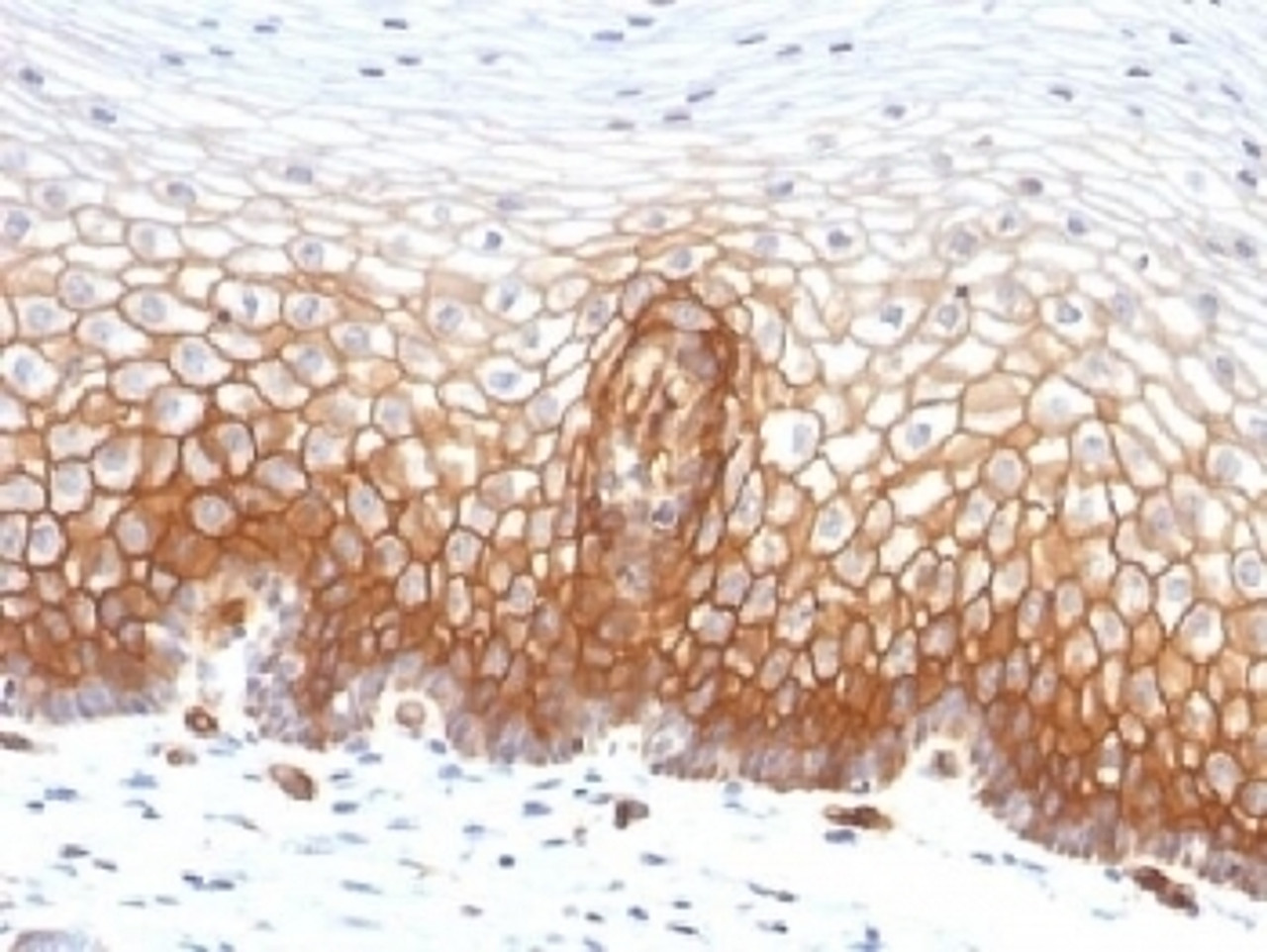 IHC testing of FFPE human cervical carcinoma with Thrombomodulin antibody (clone THBD/1591) . HIER: boil tissue sections in 10mM Tris buffer with 1mM EDTA, pH 9, for 10-20 min followed by cooling at RT for 20 min.