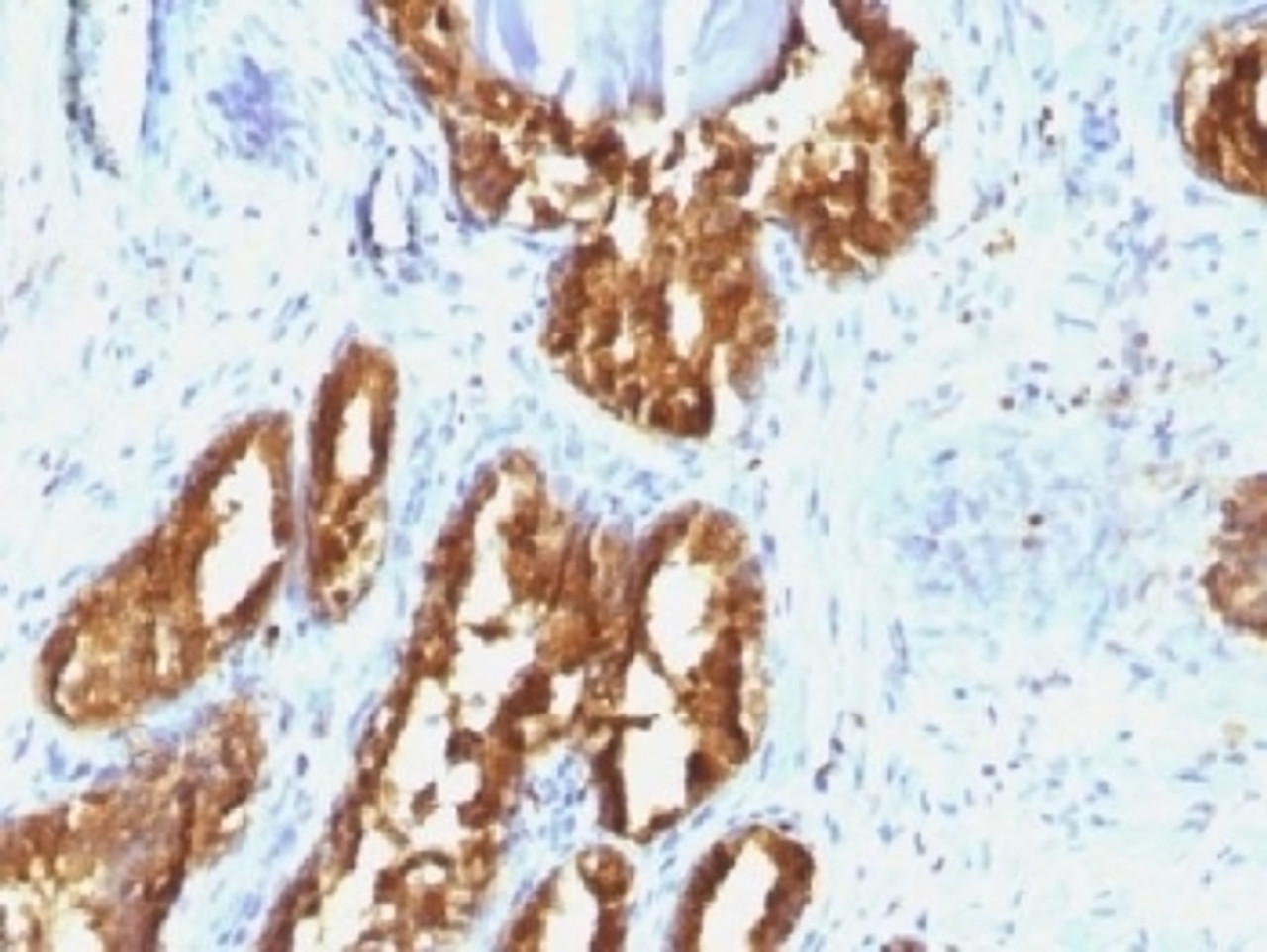 IHC testing of human prostate carcinoma with PSAP antibody (clone ACCP/1338) . Required HIER: boil tissue sections in 10mM citrate buffer, pH 6, for 10-20 min followed by cooling at RT for 20 min.