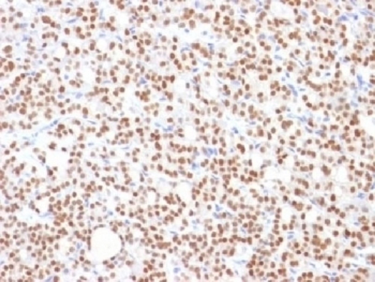 IHC testing of FFPE human thyroid carcinoma with PAX8 antibody (clone PAX8/1492) . Required HIER: boil tissue sections in 10mM Tris buffer with 1mM EDTA, pH 9, for 10-20 min followed by cooling at RT for 20 minutes.