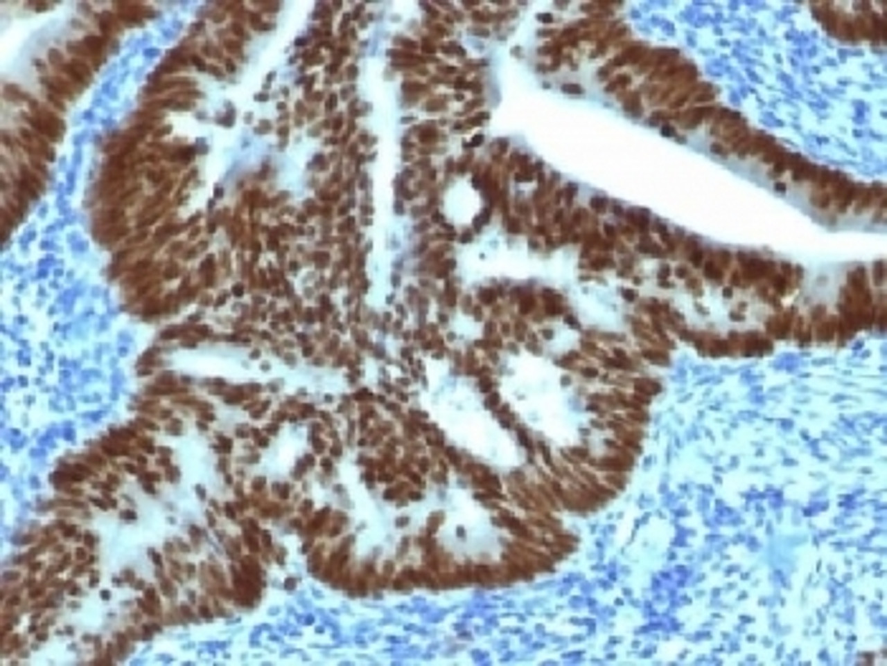 IHC testing of FFPE human colon carcinoma with CDX2 antibody (clone CDX2/1690) . Required HIER: boil sections in 10mM citrate buffer, pH6, for 10-20 min.