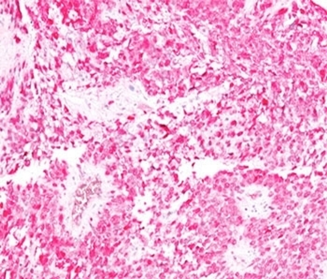 IHC testing of human melanoma stained with S100B antibody + AEC chromogen (clone 4C4.9) . No special pretreatment is required for IHC staining of formalin-paraffin tissues.