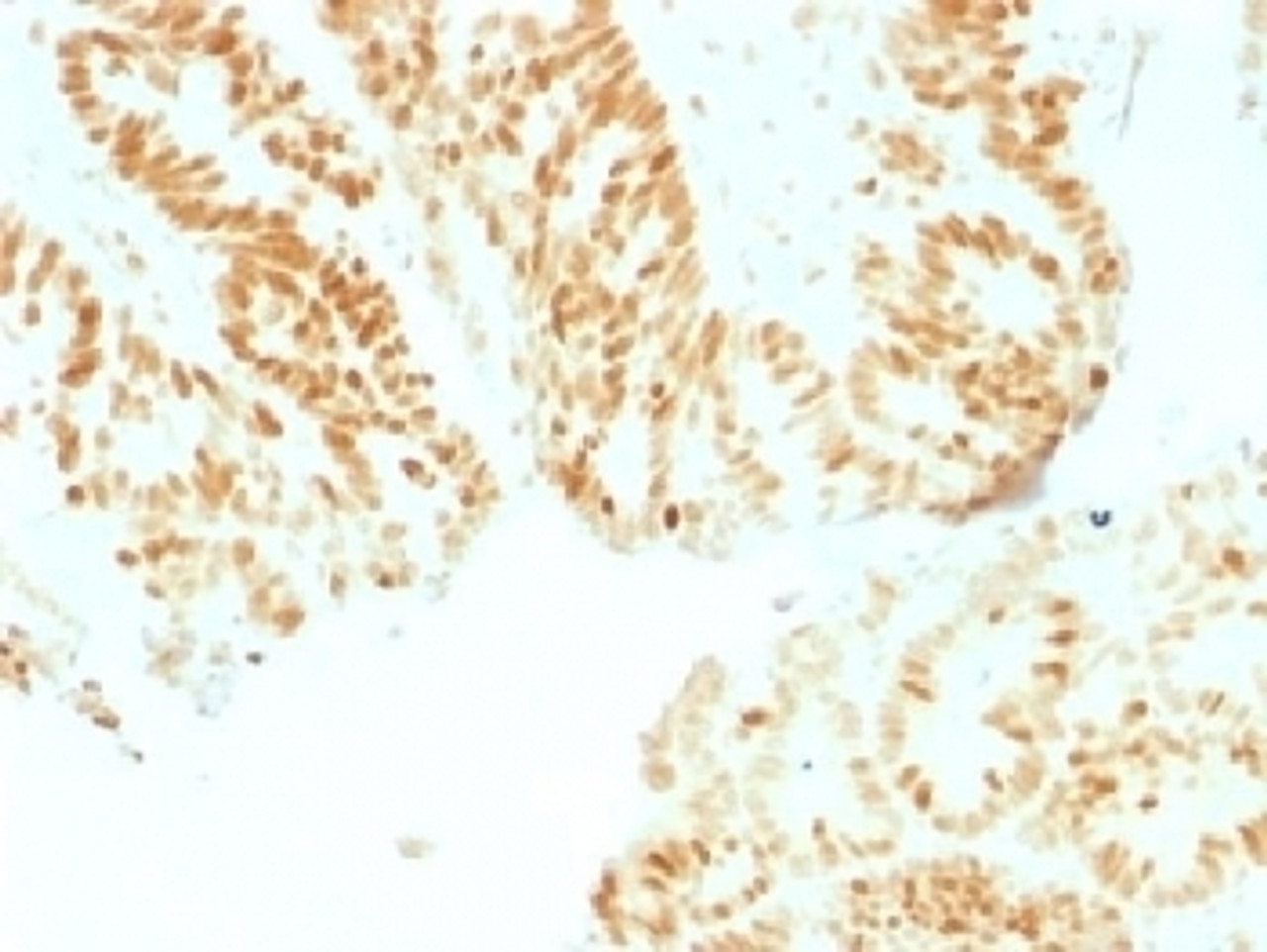 IHC testing of human colon with Rb antibody (clone RB1/1754) . Required HIER: boil tissue sections in 10mM citrate buffer, pH 6, for 10-20 min followed by cooling at RT for 20 min.