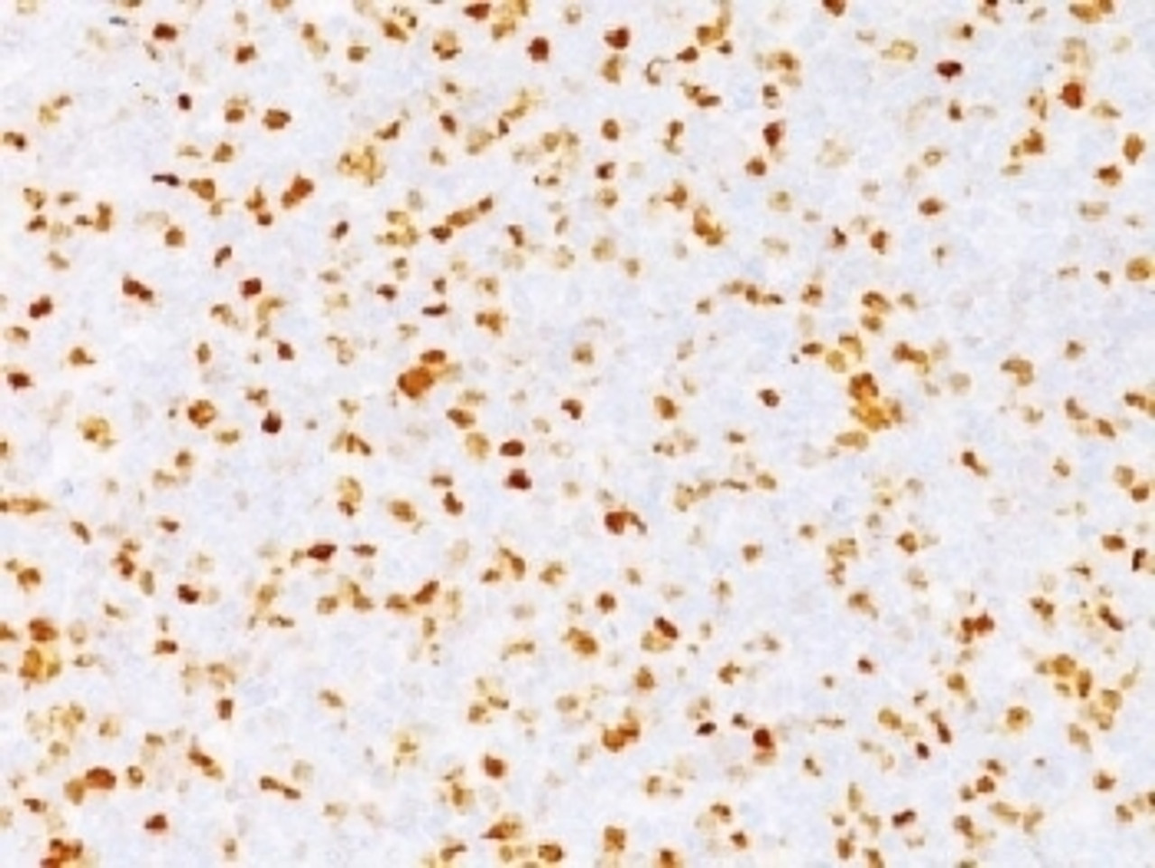 IHC testing of FFPE human bladder carcinoma with TOP2A antibody (clone TOP2A/1362) . Required HIER: boil sections in 10mM citrate buffer, pH6, for 10-20 min followed by cooling at RT for 20 min.