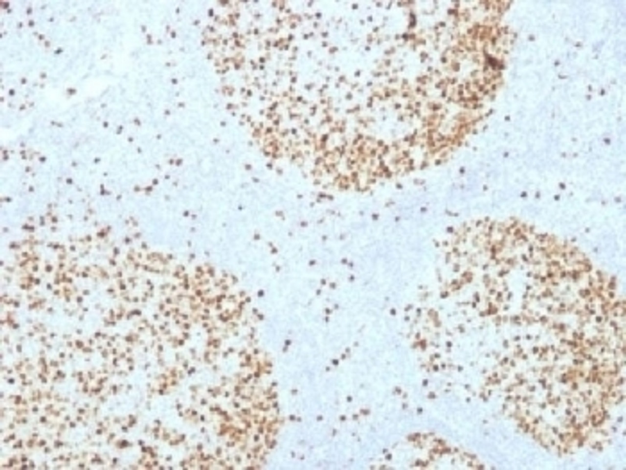 IHC testing of FFPE human tonsil with Topoisomerase II alpha antibody (clone TOP2A/1361) . Required HIER: boil sections in 10mM citrate buffer, pH6, for 10-20 min followed by cooling at RT for 20 min.