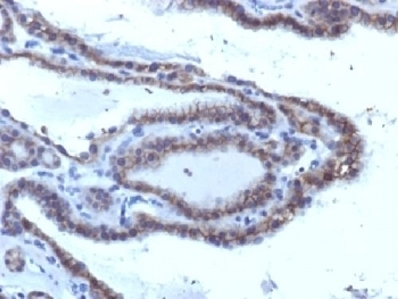 IHC testing of FFPE human thyroid carcinoma with TSHR antibody (clone SPM223) . Required HIER: boil tissue sections in 10mM Tris with 1mM EDTA, pH 9, or 10mM citrate buffer, pH 6, for 10-20 min followed by cooling at RT for 20 min.