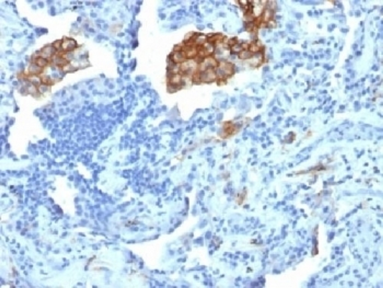 IHC testing of FFPE human lung carcinoma with DC-SIGN antibody (clone C209/1781) . Required HIER: boil tissue sections in 10mM Tris with 1mM EDTA, pH 9, for 10-20.