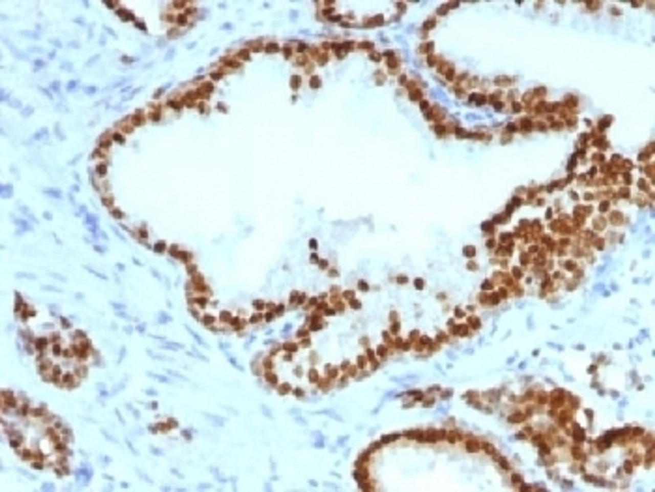 IHC testing of FFPE human prostate carcinoma with FOXA1 antibody (clone FOXA1/1241) . HIER: boil sections in 10mM Tris with 1mM EDTA, pH9 for 10-20 min followed by cooling at RT for 20 min.
