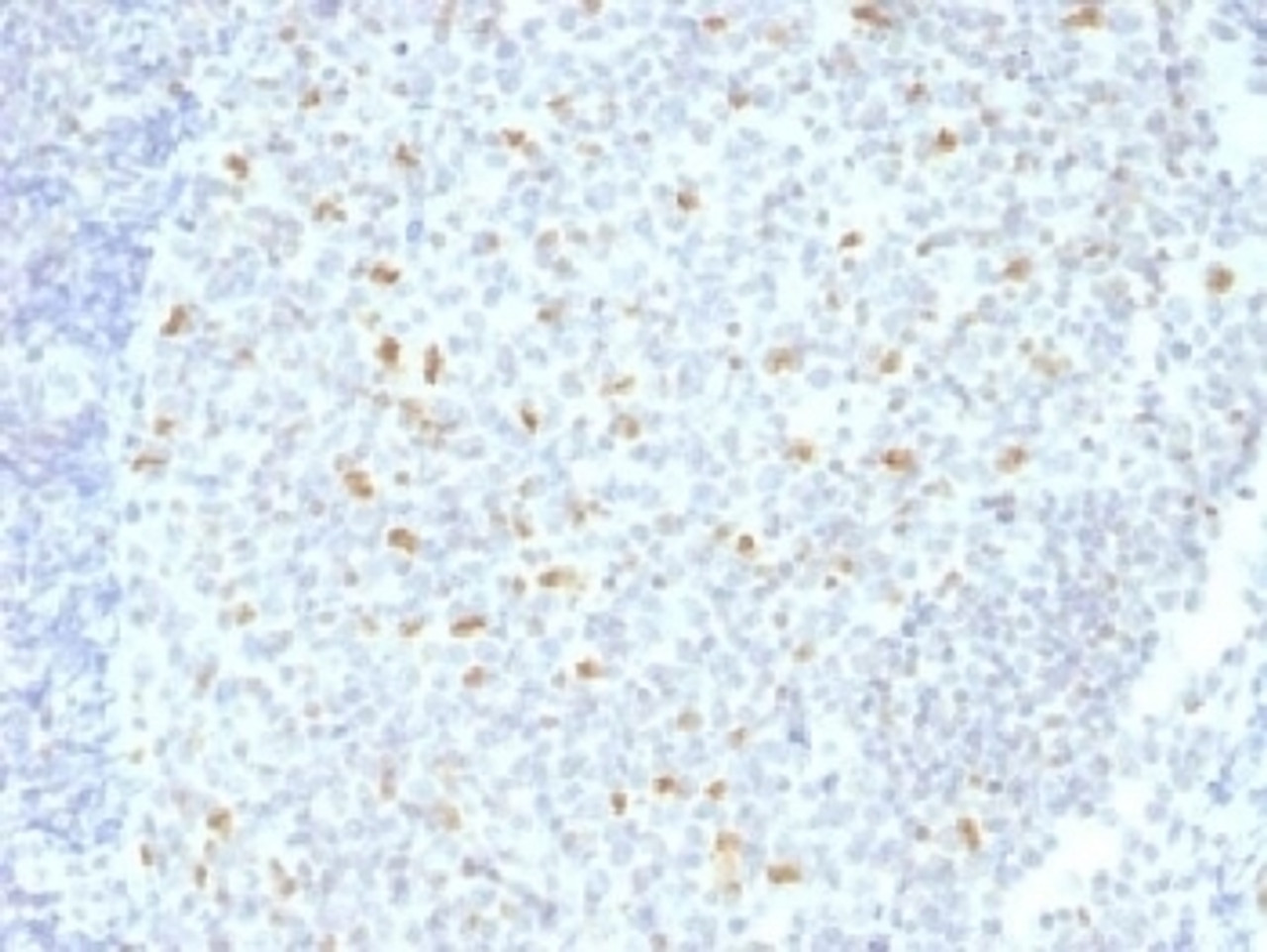 IHC testing of FFPE human tonsil tissue with Bcl6 antibody (clone BCL6/1526) . Required HIER: boil tissue sections in 10mM Tris with 1mM EDTA, pH 9, for 10-20 min.