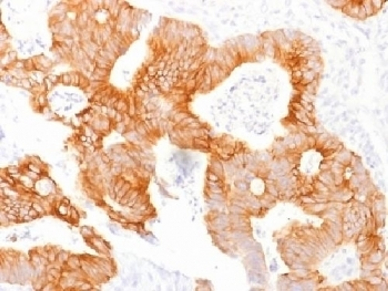 IHC testing of FFPE human colorectal carcinoma and Ep-CAM antibody (clone EGP40/1798) . Required HIER: steam sections in pH6 citrate buffer for 10-20 min.