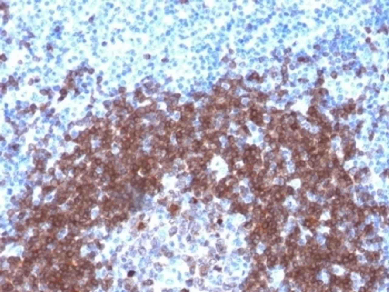IHC testing of FFPE human tonsil with recombinant CD79a antibody (clone IGA/1790R) . Required HIER: boil tissue sections in 10mM citrate buffer, pH 6, for 10-20 min followed by cooling at RT for 20 min.