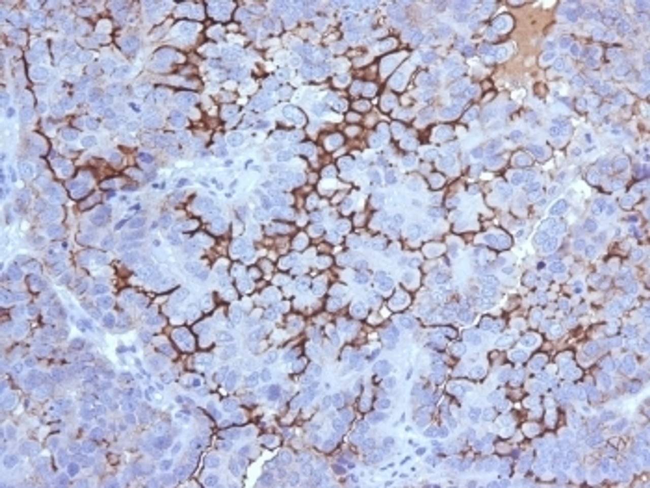 IHC testing of FFPE human ovarian carcinoma with MUC16 antibody (clone 5E11) . Required HIER: steam section in pH6 citrate buffer for 20 min and allow to cool prior to testing.