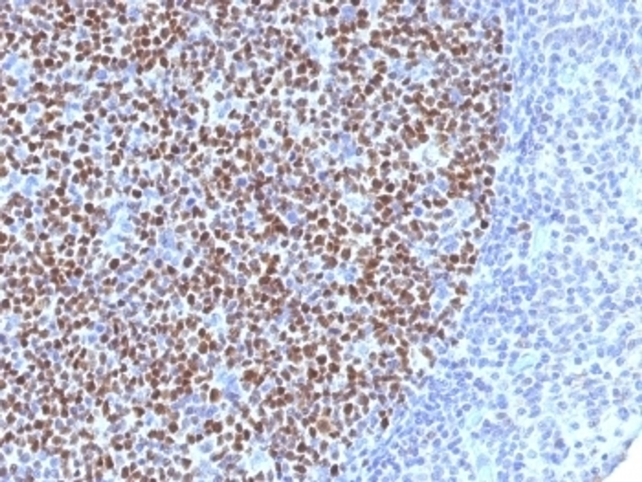 IHC testing of FFPE human tonsil tissue with Bcl6 antibody (clone BCL6/1527) . Required HIER: boil tissue sections in 10mM Tris with 1mM EDTA, pH 9, for 10-20 min.