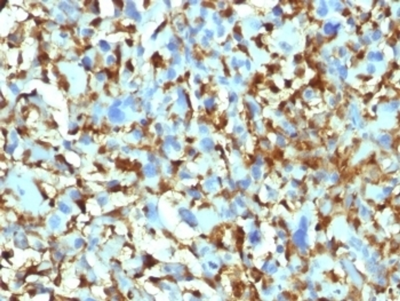 IHC testing of FFPE human histiocytoma with Factor XIIIa antibody (clone F13A1/1448) . Required HIER: boil tissue sections in 10mM citrate buffer, pH 6, for 10-20 min.