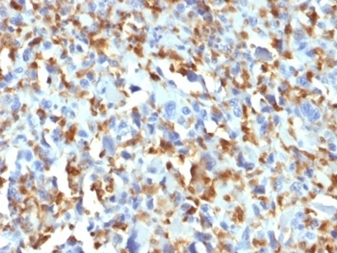 IHC testing of FFPE human histiocytoma with Factor XIIIa antibody (clone F13A1/1683) . Required HIER: boil tissue sections in 10mM citrate buffer, pH 6, for 10-20 min.