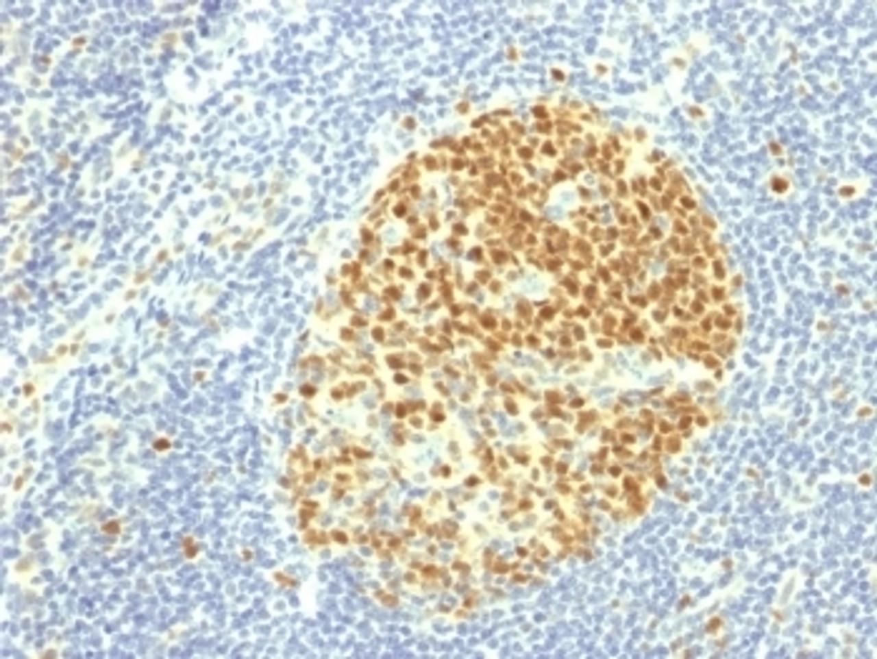 IHC testing of FFPE human tonsil with MCM7 antibody (clone MCM7/1469) . Required HIER: boil tissue sections in 10mM citrate buffer, pH 6, for 10-20 min.