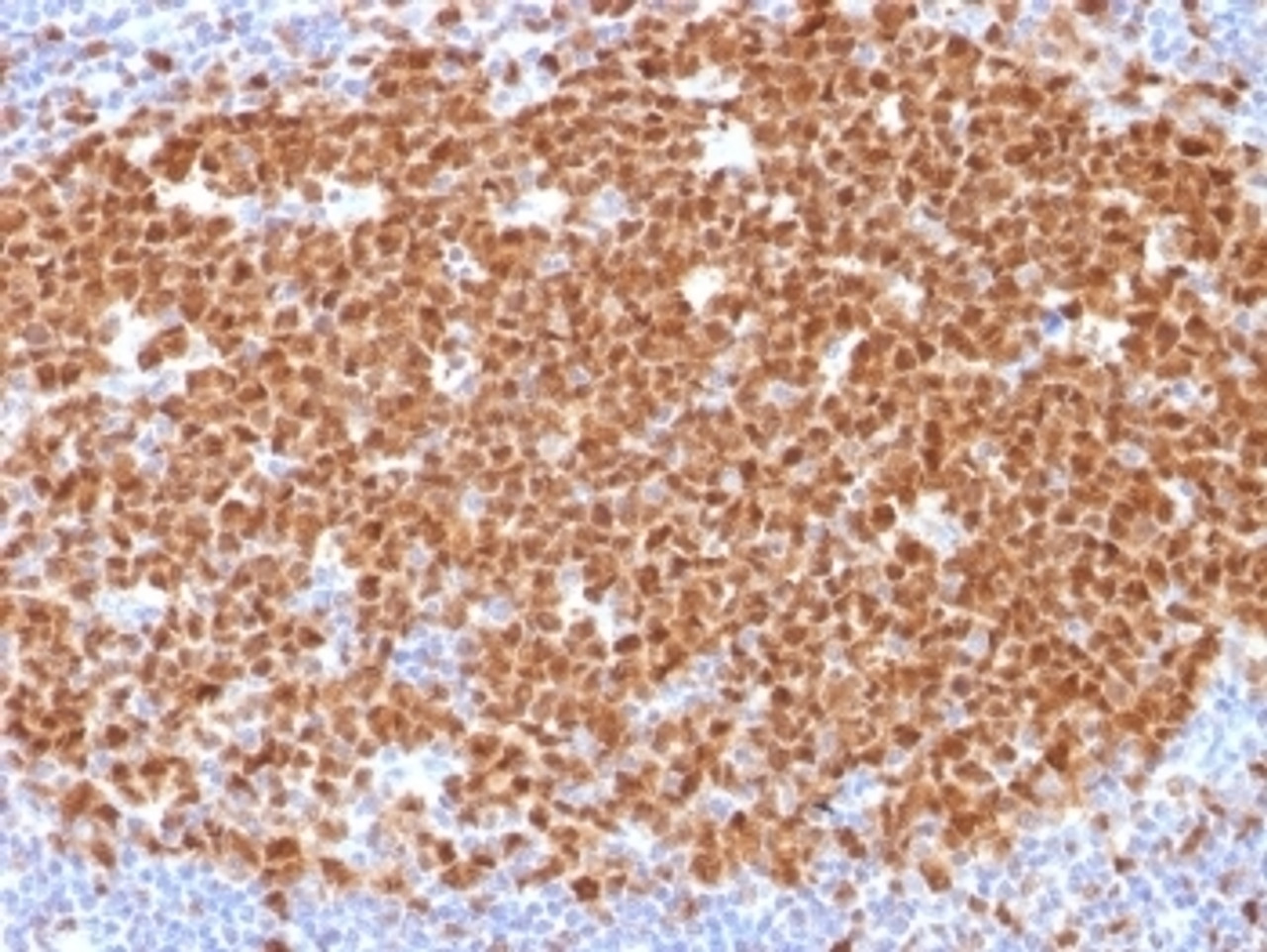 IHC testing of FFPE human tonsil with MCM7 antibody (clone MCM7/1468) . Required HIER: boil tissue sections in 10mM citrate buffer, pH 6, for 10-20 min.