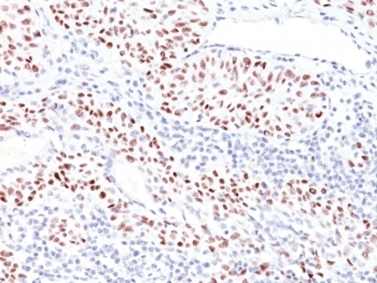 IHC: Formalin-fixed, paraffin-embedded human bladder carcinoma stained with TP53 antibody (TRP/816) . Required HIER: boil tissue sections in 10mM Citrate buffer, pH 6.0, for 10-20 min followed by cooling at RT for 20 min.