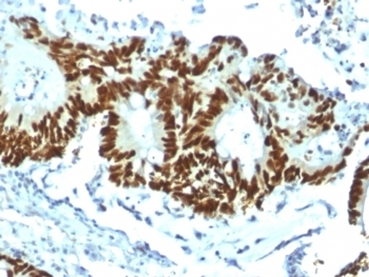 IHC testing of FFPE human colon carcinoma with recombinant p53 antibody (clone TP53/1799R) . Required HIER: boil tissue sections in 10mM citrate buffer, pH 6, for 10-20 min.