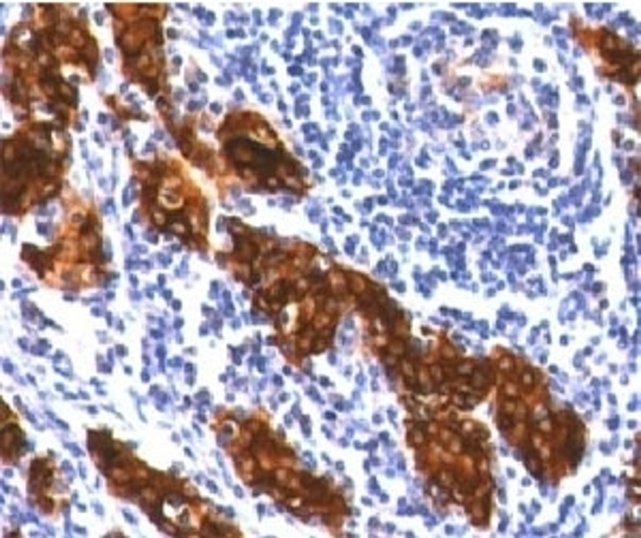 IHC testing of FFPE thyroid tissue stained with Thyroglobulin antibody (clone TG157-2) .