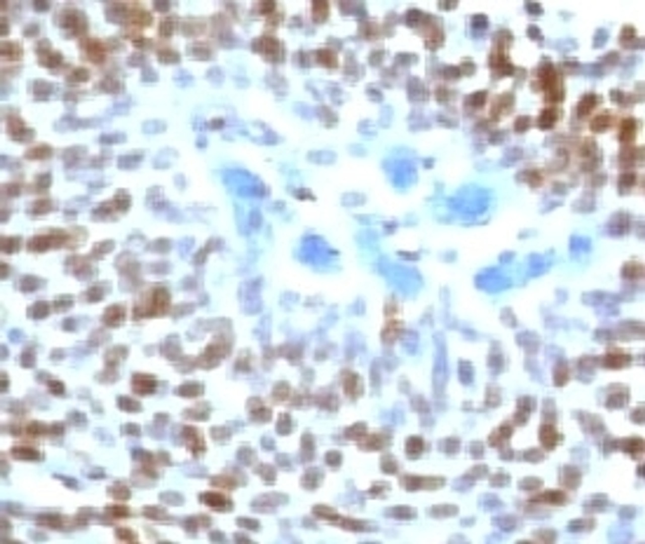 IHC staining of human colon carcinoma with p53 antibody (CTA53-1) .