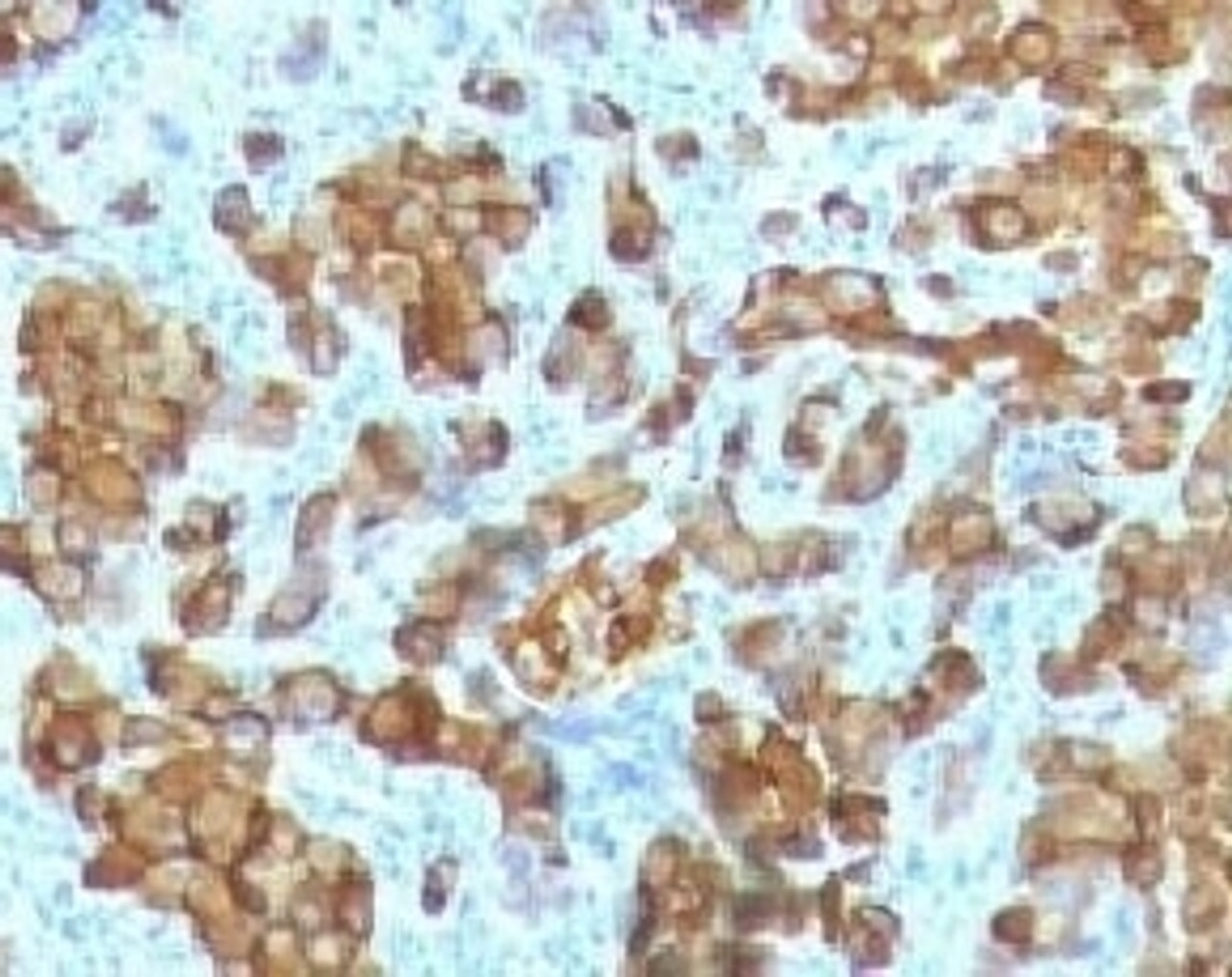 Formalin-fixed, paraffin-embedded human melanoma stained with Melan-A antibody