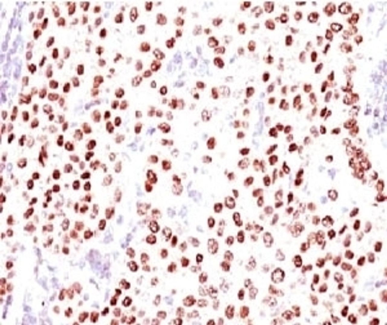 IHC testing of FFPE human breast carcinoma with Progesterone receptor antibody (clone PGSR17) .