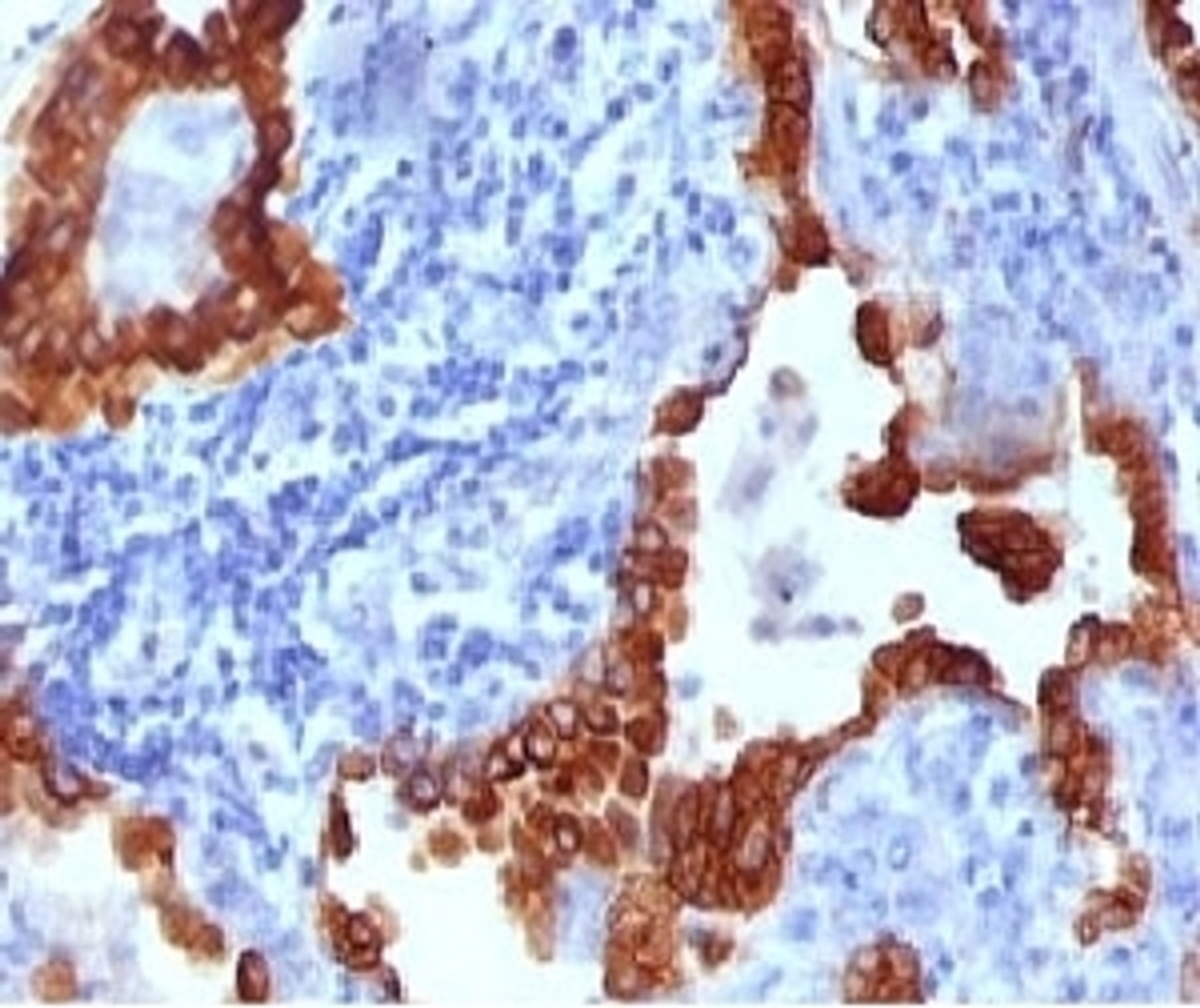 IHC testing of FFPE human lung carcinoma stained with Cytokeratin 8 antibody (CYKN8-1) .