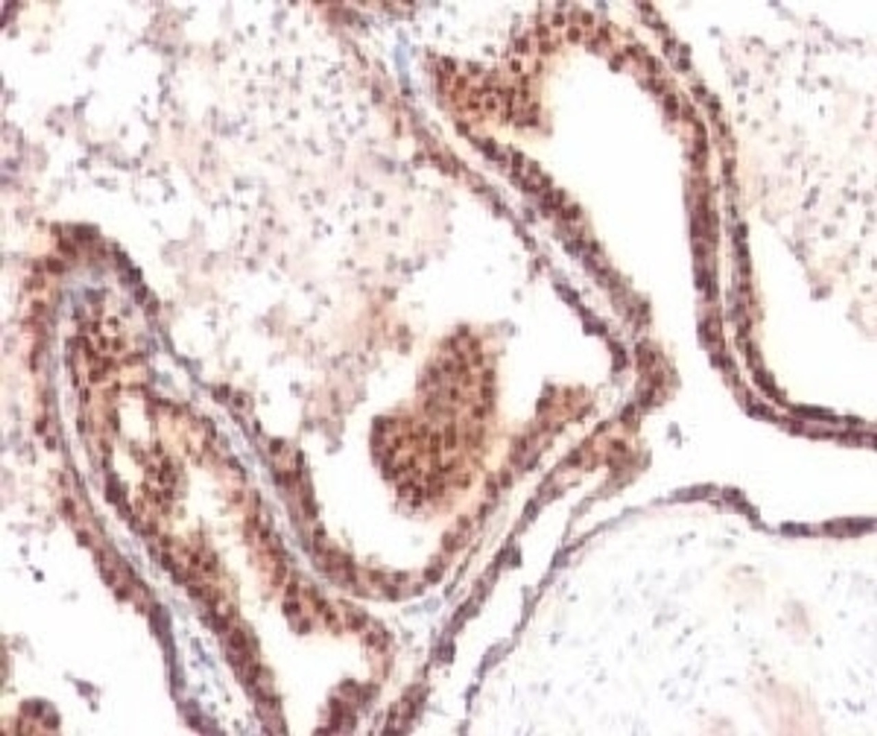 IHC testing of FFPE human prostate cancer and p27Kip1 antibody (clone KIP27-1) .