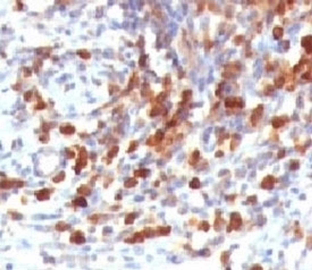 IHC testing of human lymphoma and CD79a antibody (CDLA79a-1) .