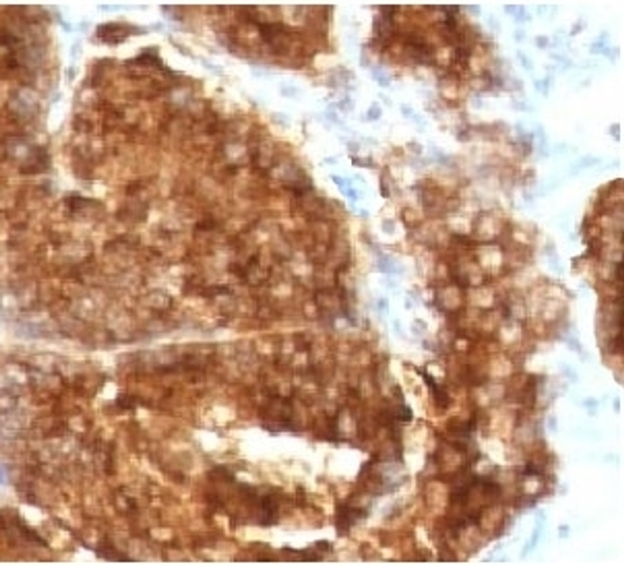 IHC staining of human prostate carcinoma with TAG-72 antibody