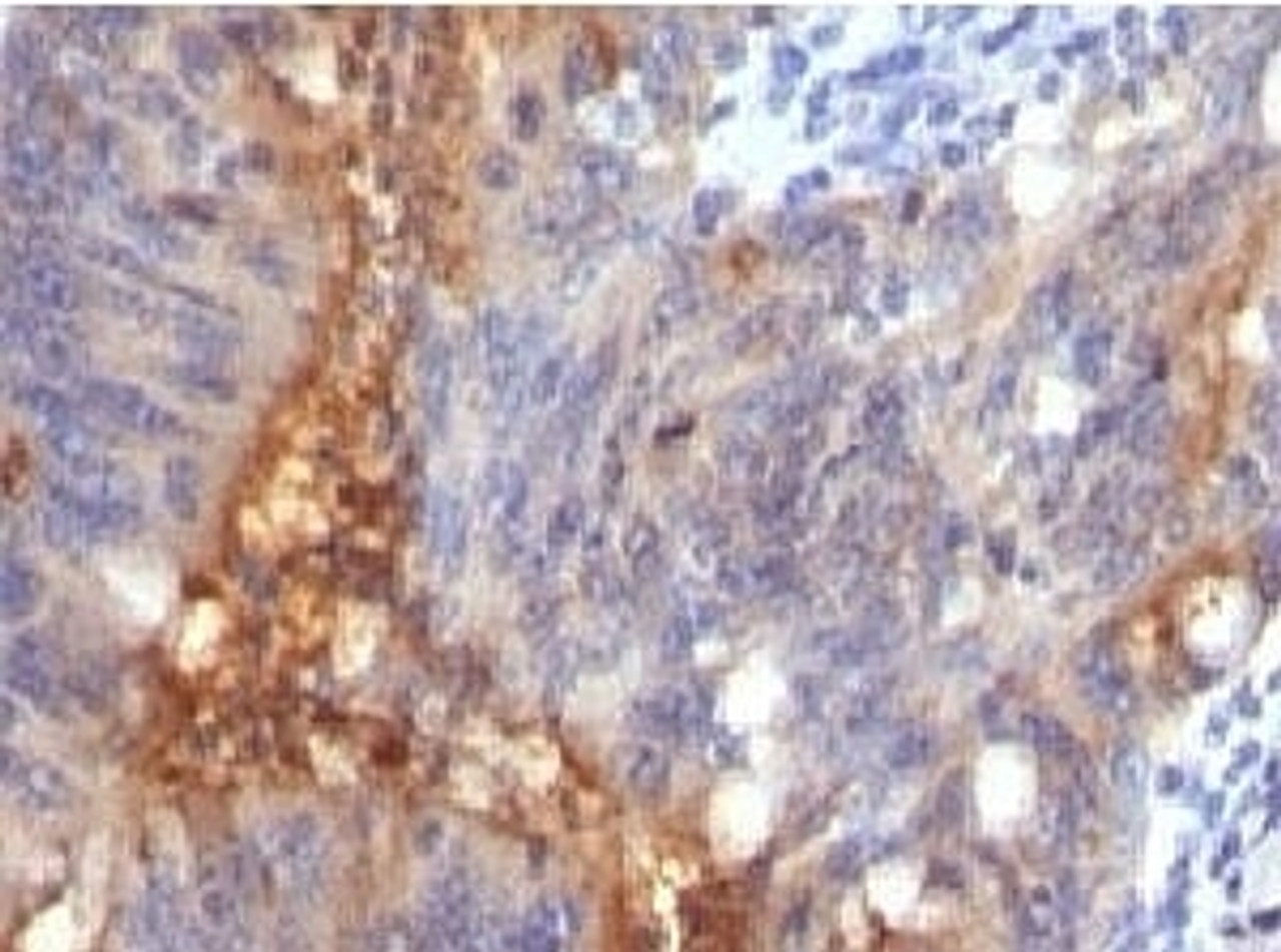 IHC testing of human colon carcinoma and Secretory Component Glycoprotein antibody (SRGP85) .