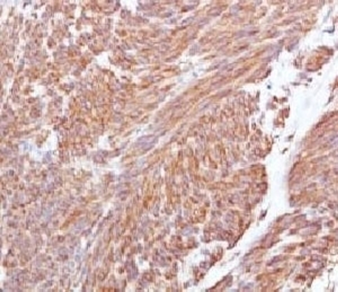 IHC testing of FFPE human gastrointestinal stromal tumor (GIST) and CD117 antibody (CLDA117) .