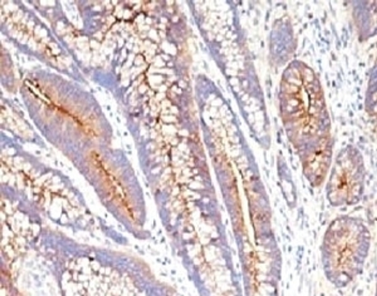 FFPE staining of human colon carcinoma with CEA antibody (CCM661) .