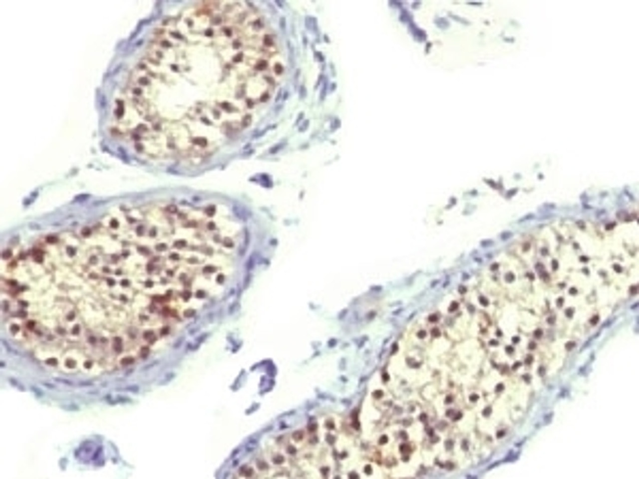 IHC testing of FFPE human testicular carcinoma and Thymidylate Synthase antibody (TYSY9) .