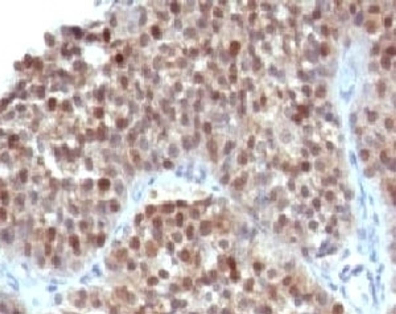 IHC testing of human bladder carcinoma and p21 antibody (WAF21-1) .