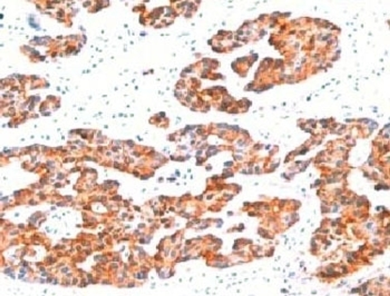 IHC testing of FFPE human breast carcinoma with Basic Cytokeratin antibody.