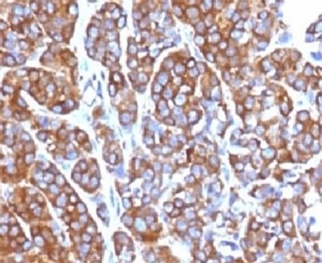 IHC testing of FFPE human melanoma with Moesin antibody