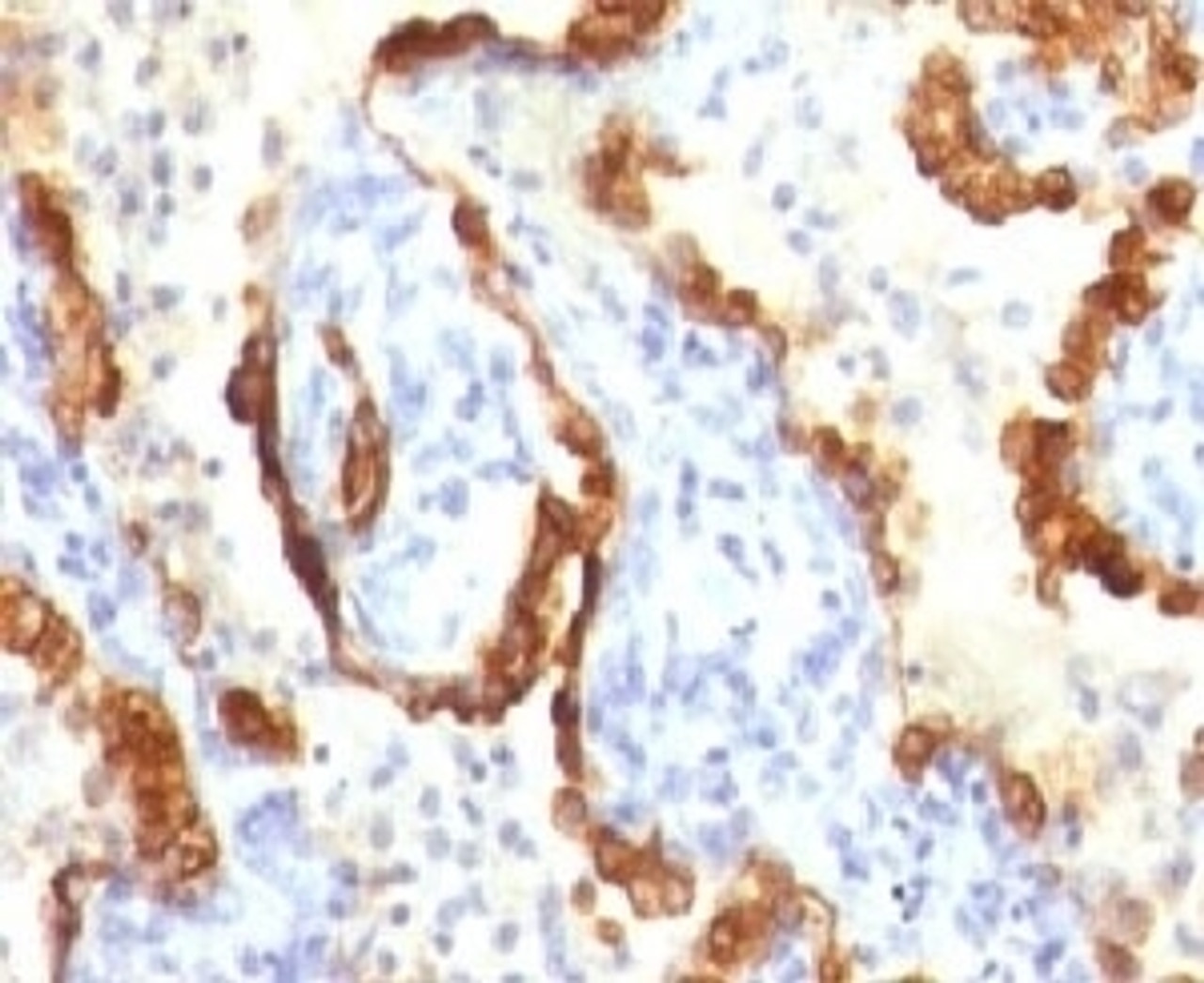 IHC testing of FFPE human lung carcinoma and Cytokeratin 18 antibody.