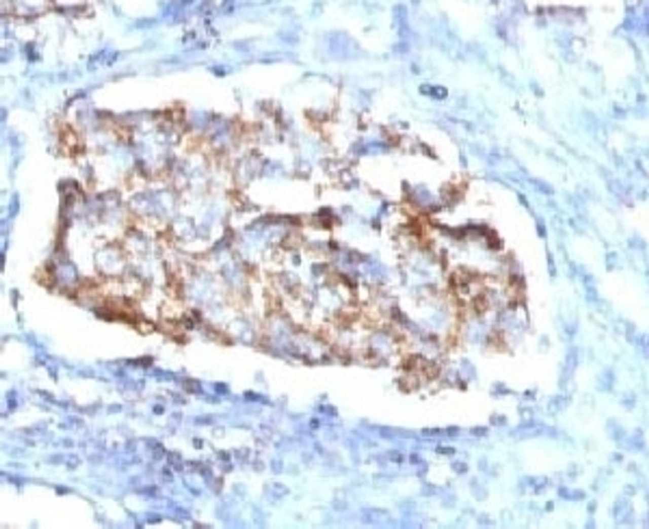 IHC testing of human lung carcinoma and HSP60 antibody