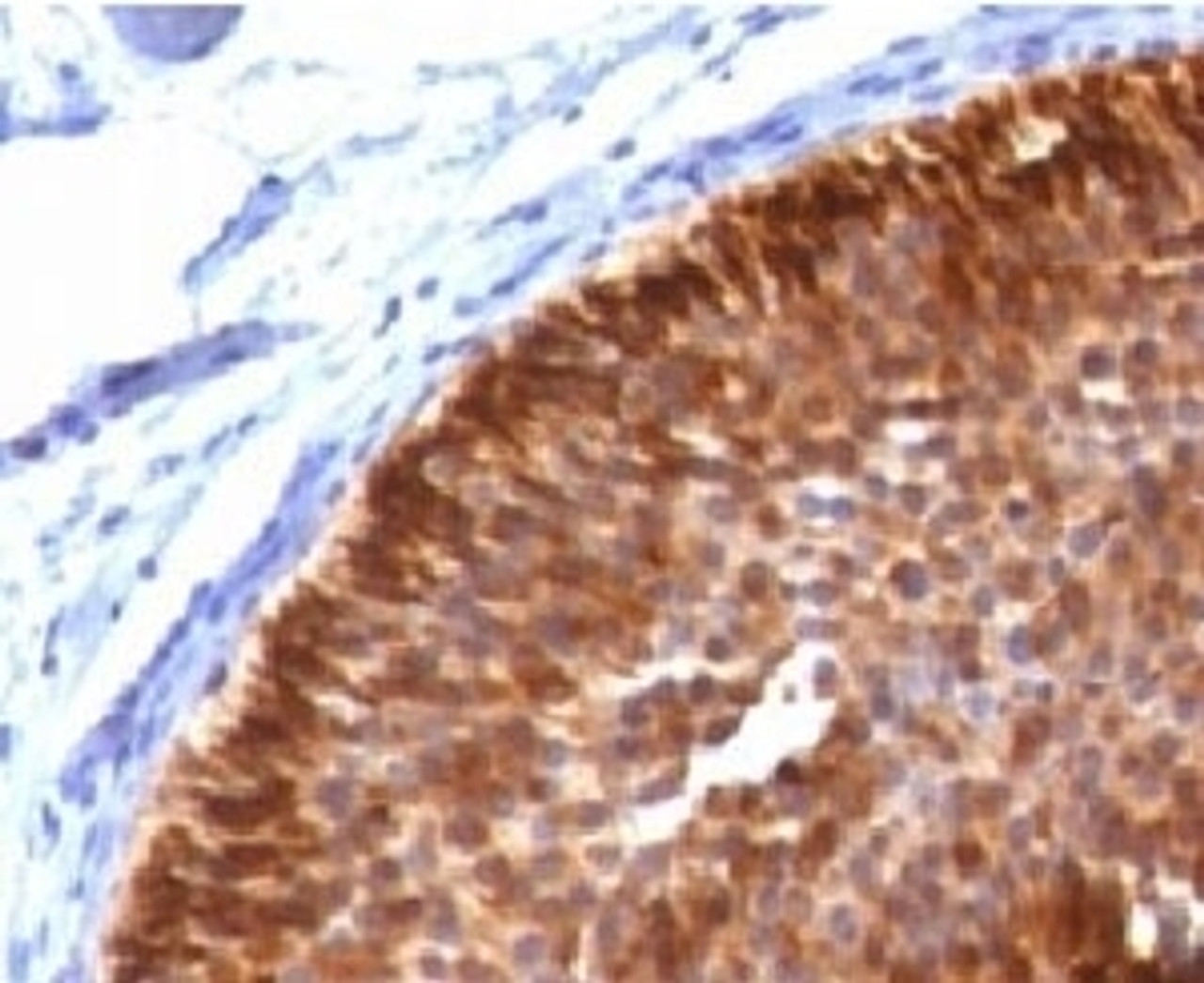 IHC testing of FFPE bladder carcinoma and Cytokeratin 17 antibody.